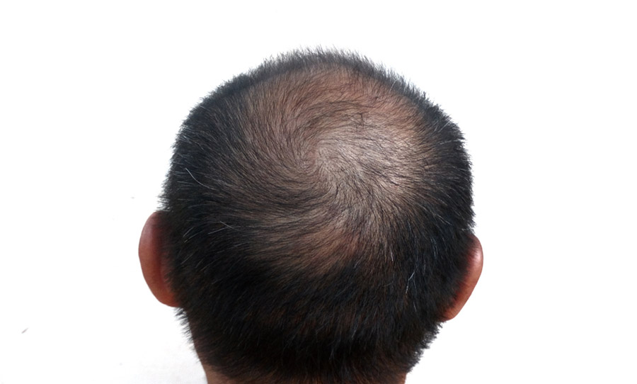 أسباب تساقط الشعر من الخلف وطرق العلاج