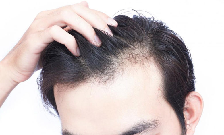 ما هو علاج تساقط الشعر