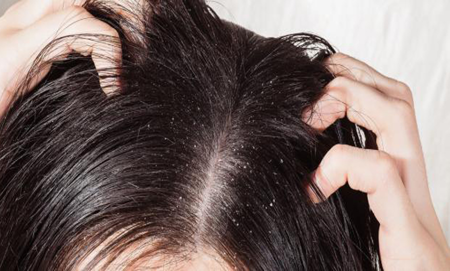 العلاقة بين تساقط الشعر والقشرة وأفضل العلاجات