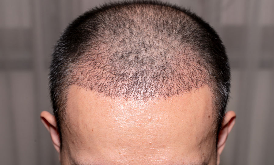 نتائج عملية زراعة الشعر بعد شهرين وأهم النصائح بعد العملية