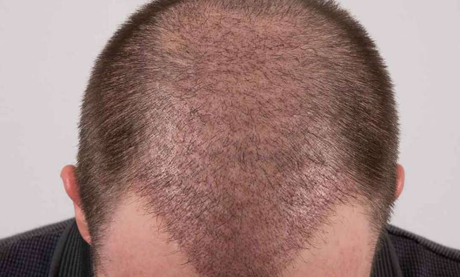 زراعة الشعر بعد ثلاث اسابيع