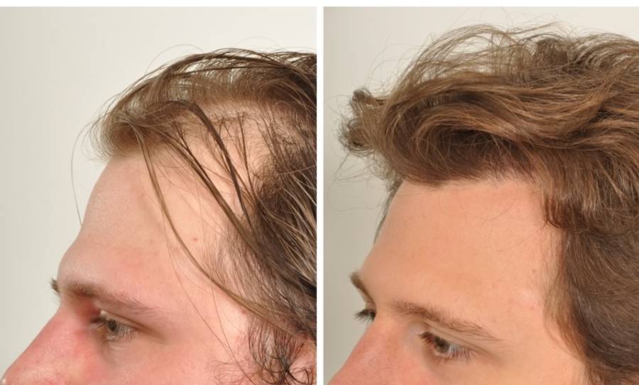 زراعة الشعر قبل وبعد بالصور