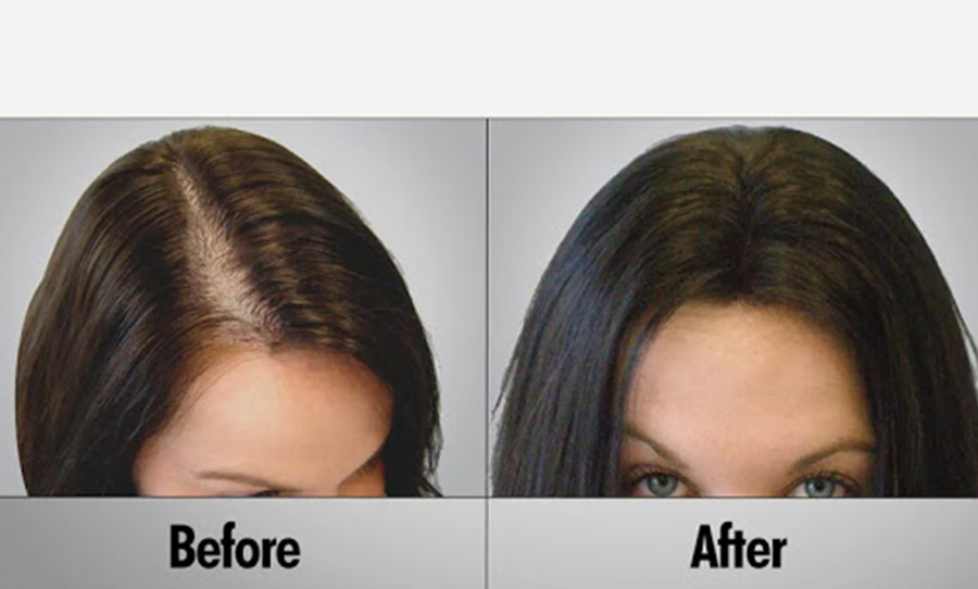 صور زراعة الشعر قبل وبعد للنساء