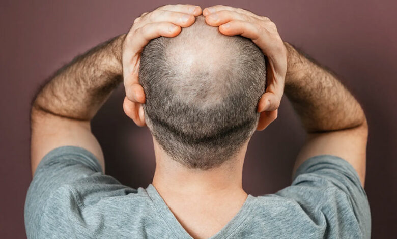 هل زراعة الشعر تسبب السرطان